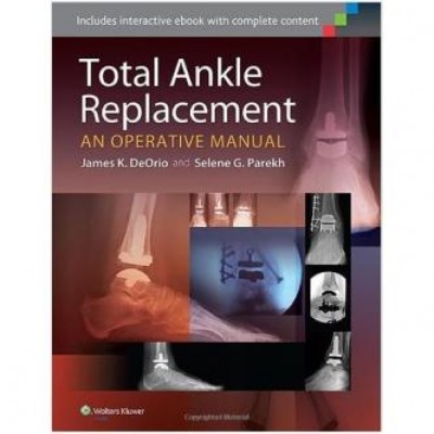 Total Ankle Replacement: An Operative Manual First Edition