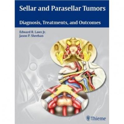 Sellar and Parasellar Tumors: Diagnosis, Treatments, and Outcomes 1st Edition