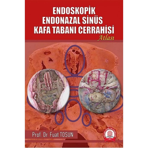 Endoskopik Endonazal Sinüs Kafa Tabanı Cerrahisi